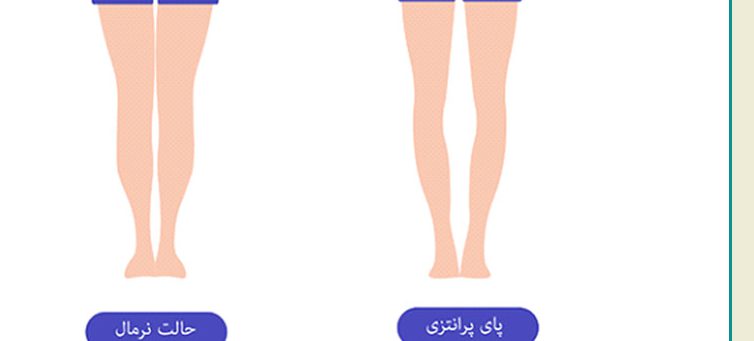 معافیت پزشکی پای پرانتزی معافیت پزشکی پای پرانتزی