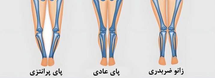 معافیت پزشکی پای پرانتزی معافیت پزشکی پای پرانتزی